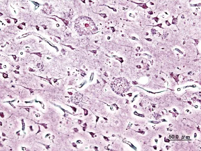El Día Internacional del Alzheimer pretende sensibilizar a la sociedad