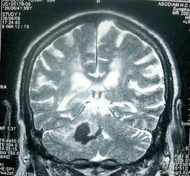 Sanidad Burgos: Cada año se detectan entre 12.400 y 22.000 nuevos casos de epilepsia en España
