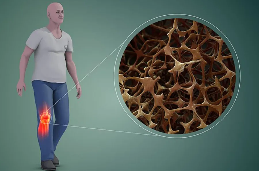 Cómo prevenir la osteoporosis, una enfermedad silenciosa
