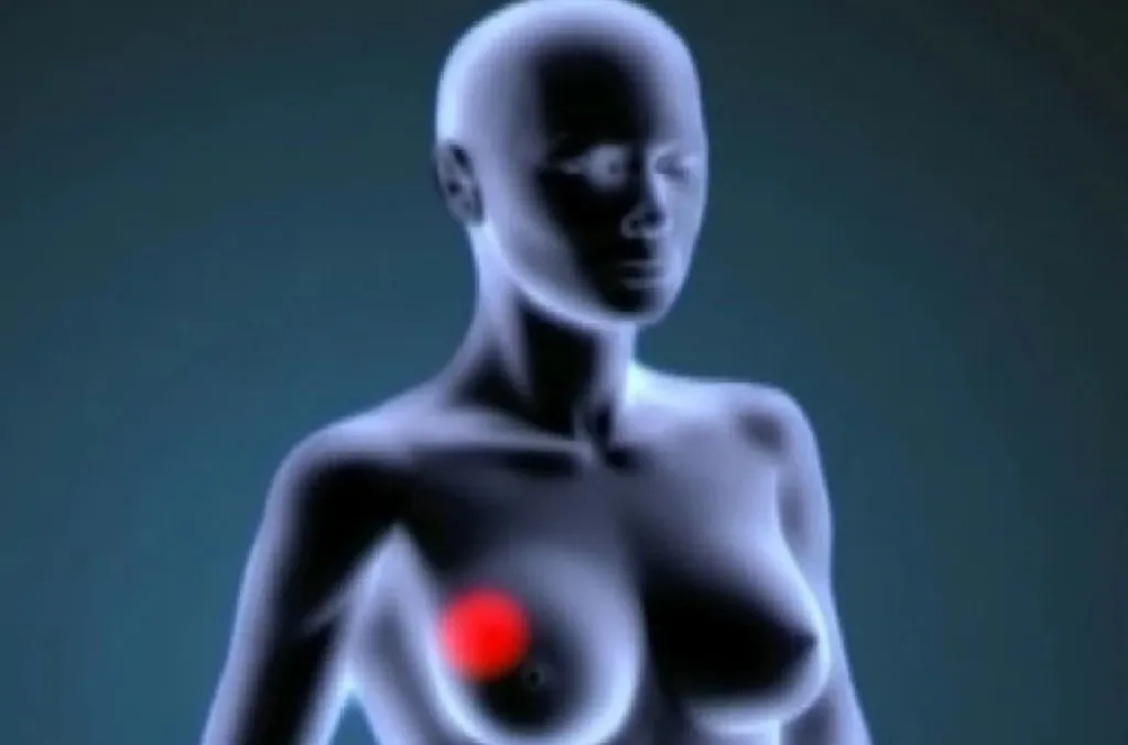Investigadores identifican 190 genes que predisponen a padecer cáncer de mama