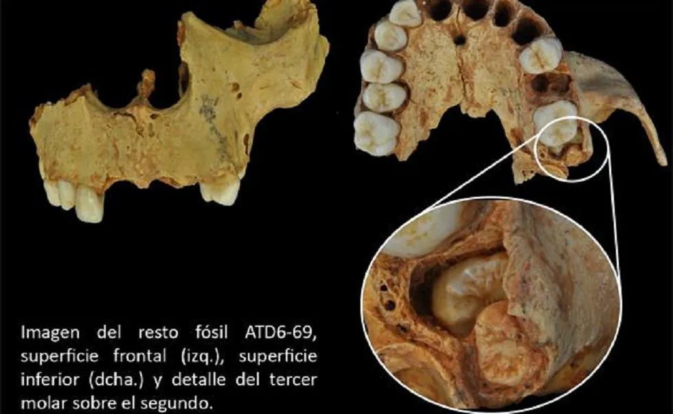 Demuestran que el Homo Antecessor tenía problemas con la muela del juicio
