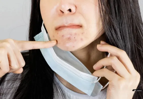 Cómo evitar el acné y la dermatitis que te puede causar la mascarilla
