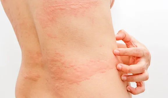 COVID-19 Burgos: Un estudio advierte de síntomas cutáneos de larga duración en pacientes con coronavirus