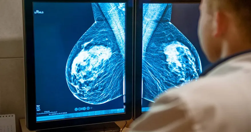 Algunas mujeres con cáncer de mama podrán evitar la quimioterapia