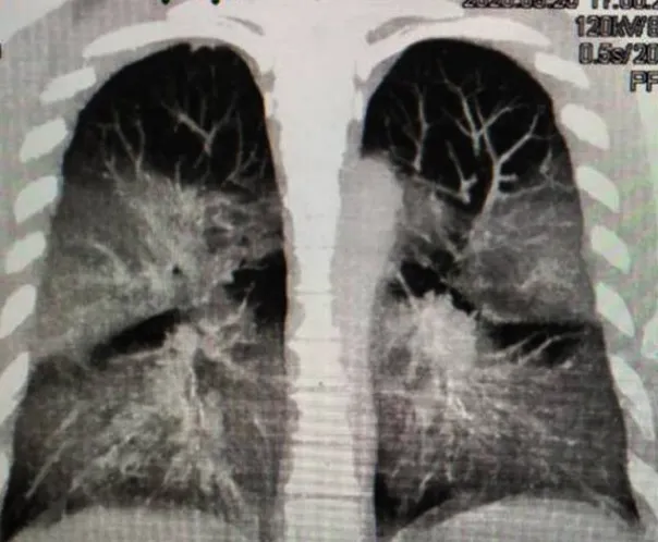 COVID-19 Burgos: Así destruye la covid los pulmones, según expertos bolivianos del mal de las alturas