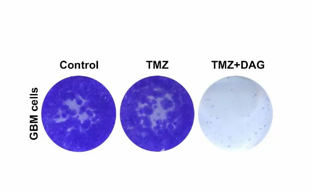 Esta terapia podría mejorar la supervivencia en los tumores cerebrales agresivos