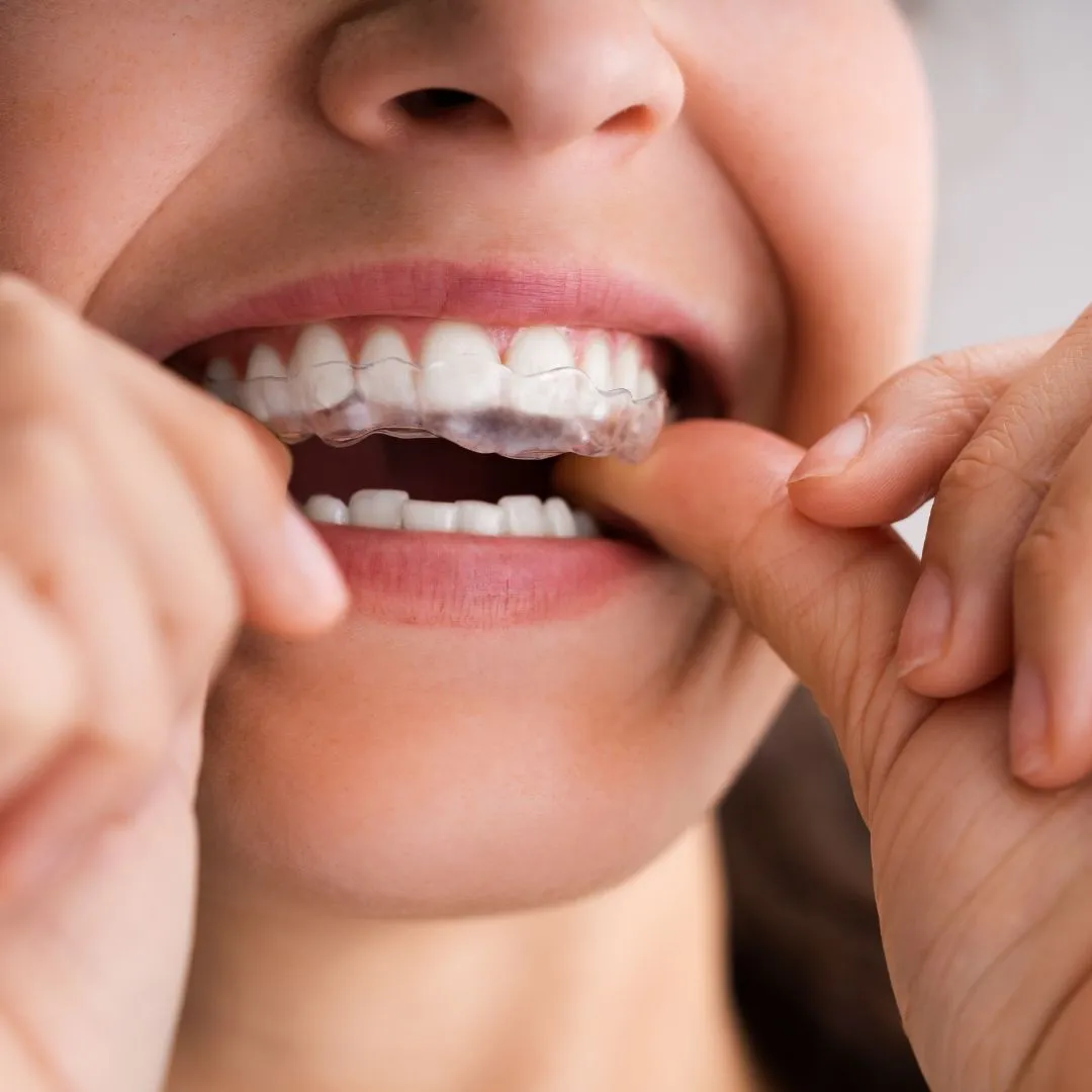 Colegios de Dentistas denuncian a varias empresas por vender alineadores dentales directamente al público