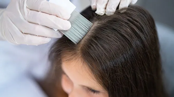 Tratamientos antipiojos: cuáles son los más efectivos