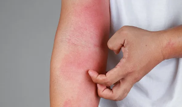 El tratamiento precoz de la dermatitis atópica podría reducir el desarrollo de la alergia alimentaria en niños