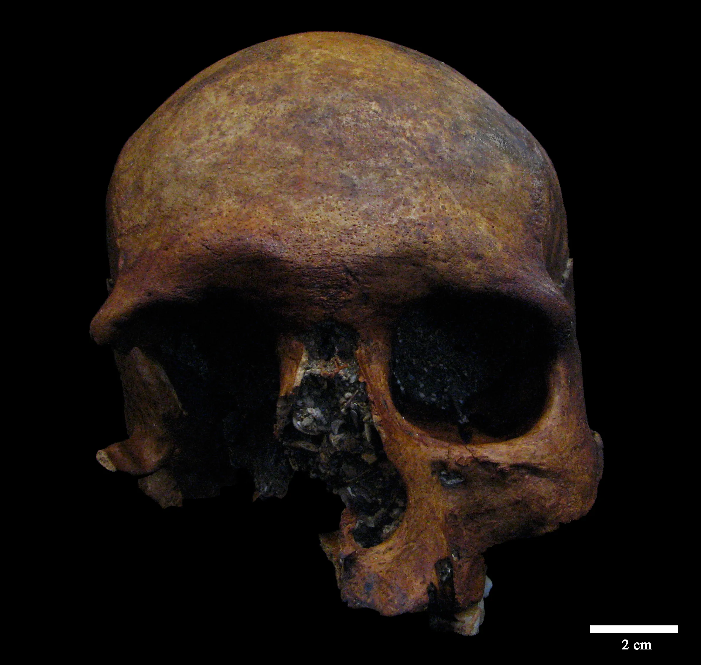 Detectado un caso de tumor craneal de época romana
