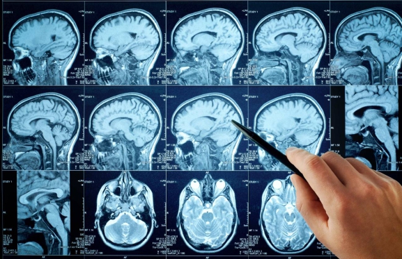 Identifican por primera vez las señales cerebrales del olvido de recuerdos desagradables